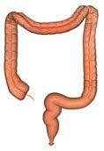 Certain types of fat are contributing to ulcerative colitis.