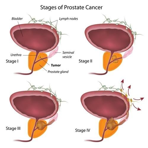 Can certain foods increase your risk for advanced prostate cancer?