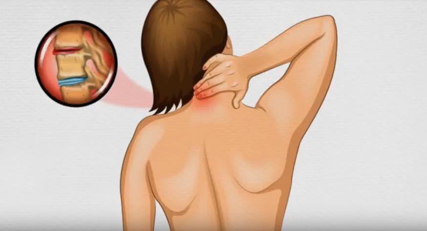 Osteoarthritis in women associated with deposits in Arteries | tissuerecovery